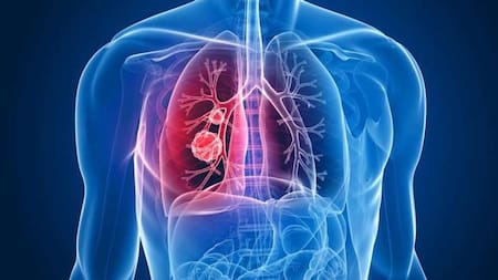 Día Mundial contra la Neumonía