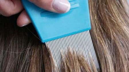 Pediculosis. Foto: X