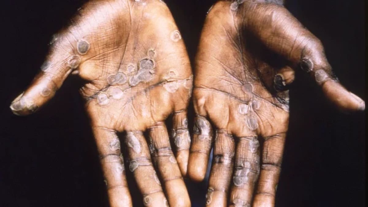 Los síntomas iniciales de la viruela del mono incluyen fiebre, dolores musculares, de cabeza, y cansancio. Foto: NA.