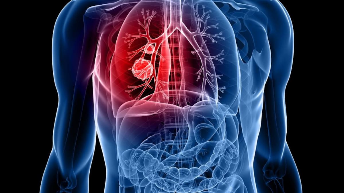 Salud - Cáncer pulmón