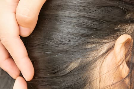 Cabello con caspa. Foto: Unsplash.