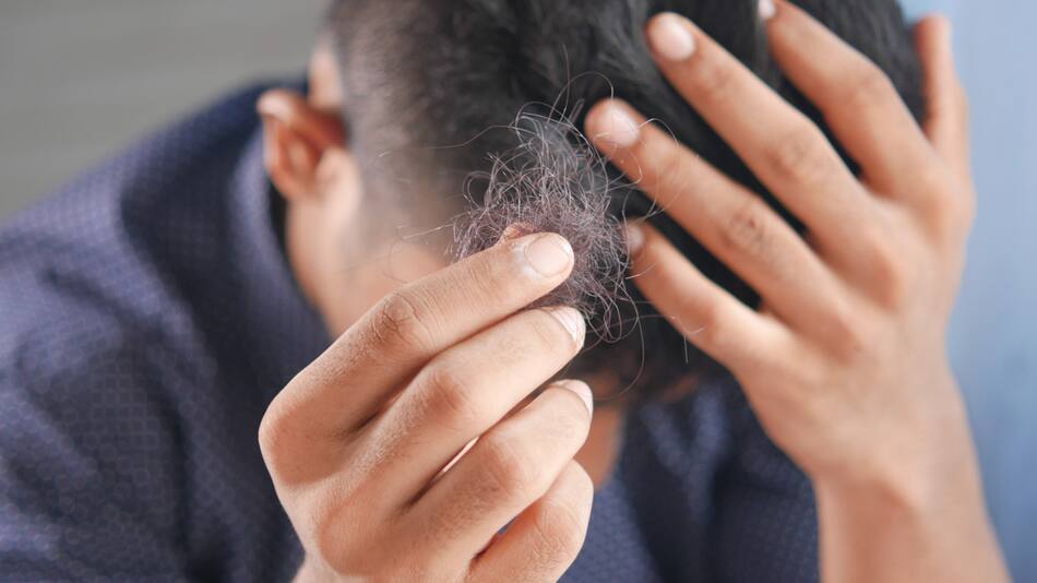 Caída de pelo, alopecia. Foto: Unsplash