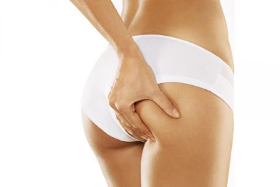 Celulitis - salud - tratamiento estético - piernas