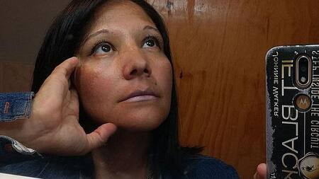 Tamara Gómez, mala praxis, liposucción