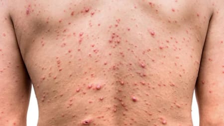 La OMS mantuvo la emergencia sanitaria internacional por la viruela del mono ante el gran número de casos