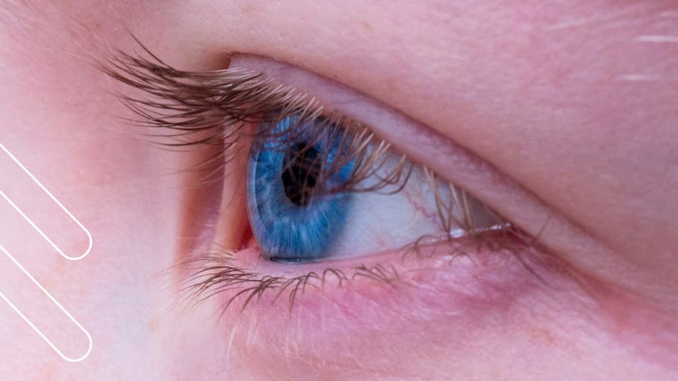 Glaucoma.