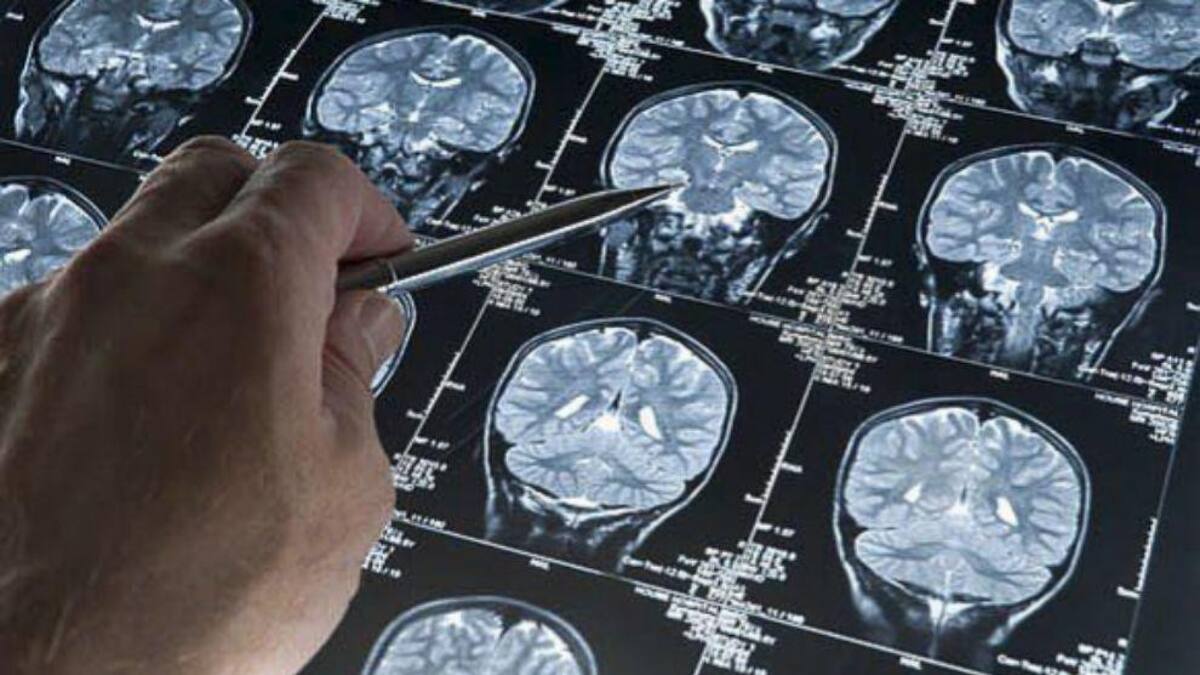 Alzheimer, enfermedad. Foto: EFE.
