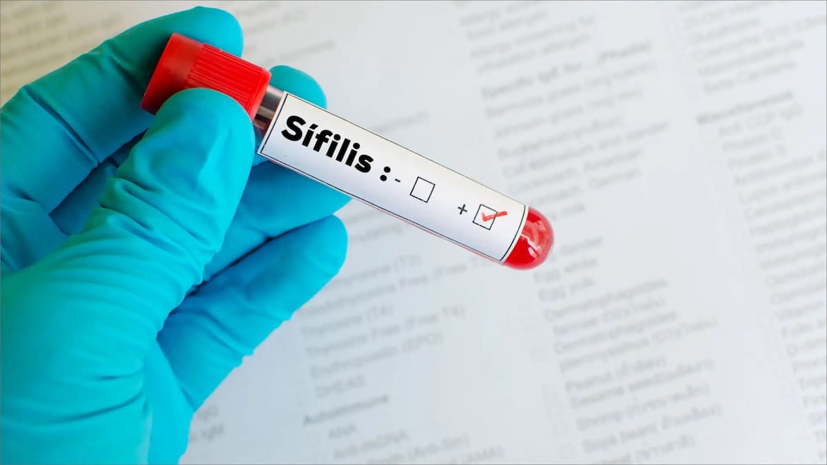 Preocupación por el aumento de casos de sífilis en la Argentina.