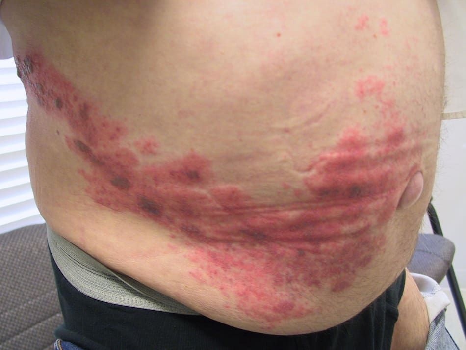 Culebrilla. Foto, Twitter: @BIOMEXCOMPANY