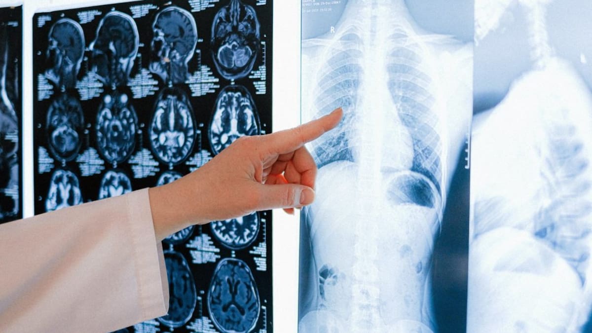 Cáncer de pulmón