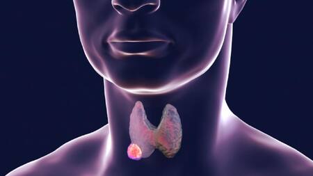 Hipotiroidismo, tiroides, salud