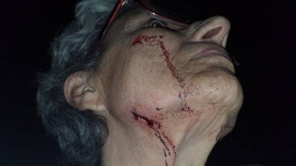Perros pitbull atacan a una mujer, le mordieron la cara y le arrancaron parte de la oreja