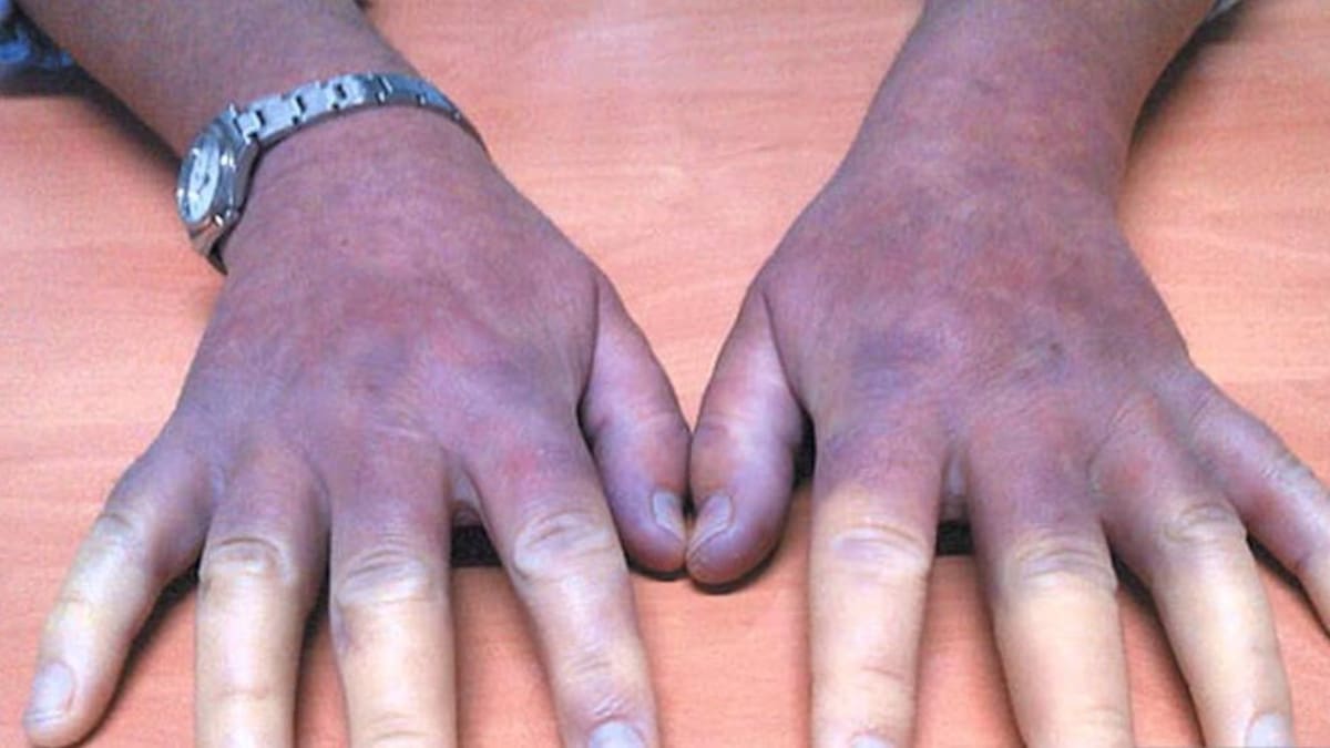 Esclerodermia: ¿cómo es la enfermedad de las manos azules?