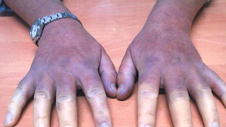 Esclerodermia - Enfermedad de las manos azules