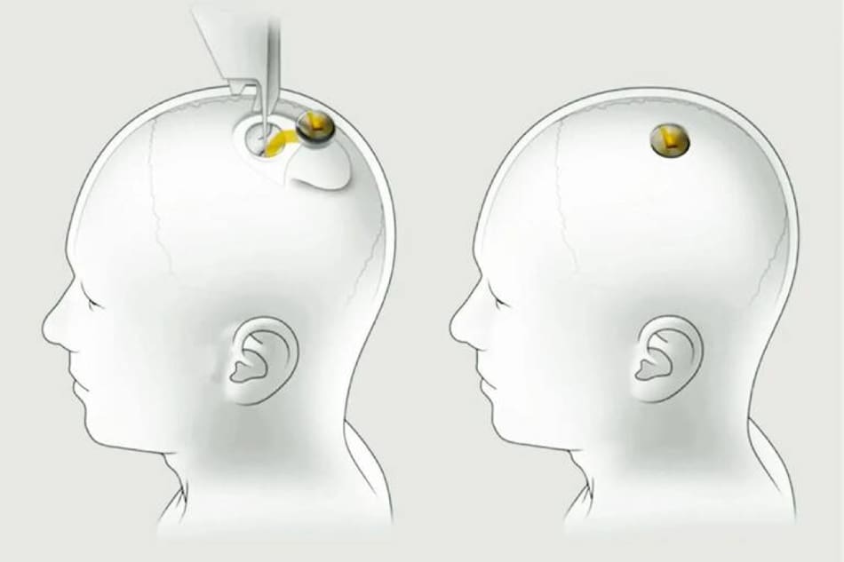 Inserción de Neuralink de chips cerebrales en humanos.