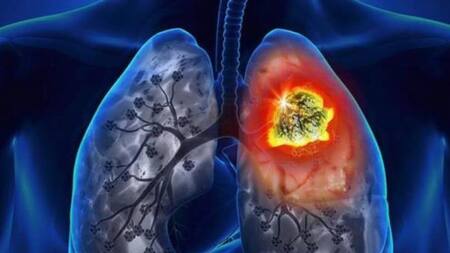 Cáncer de pulmón, salud