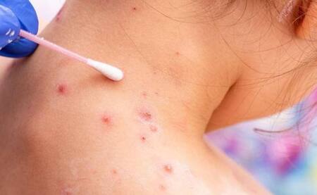 Viruela del mono. Foto: NA.