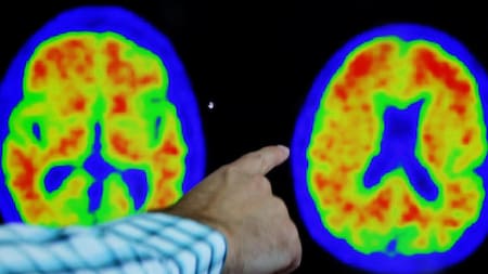 Alzheimer, salud. Foto: Reuters.