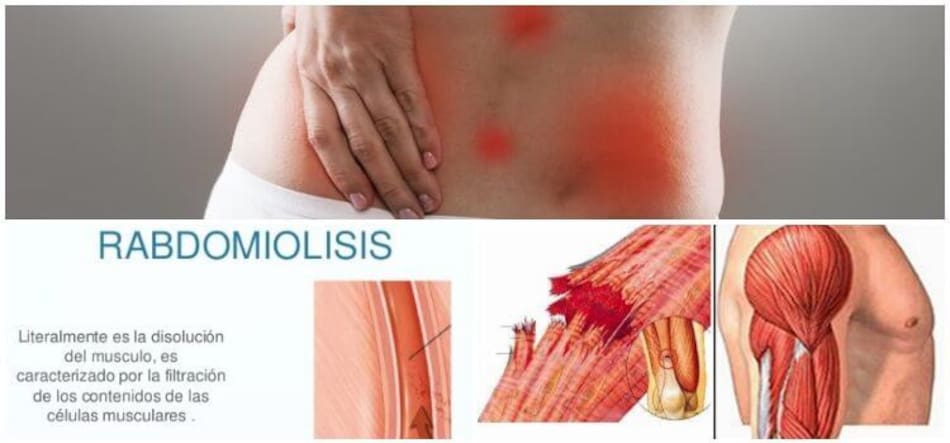 Rabdomiólisis - Salud