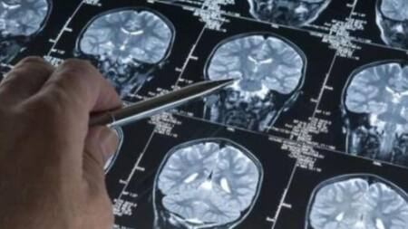 Tenias en el cuerpo de un hombre que comió carne mal cocida