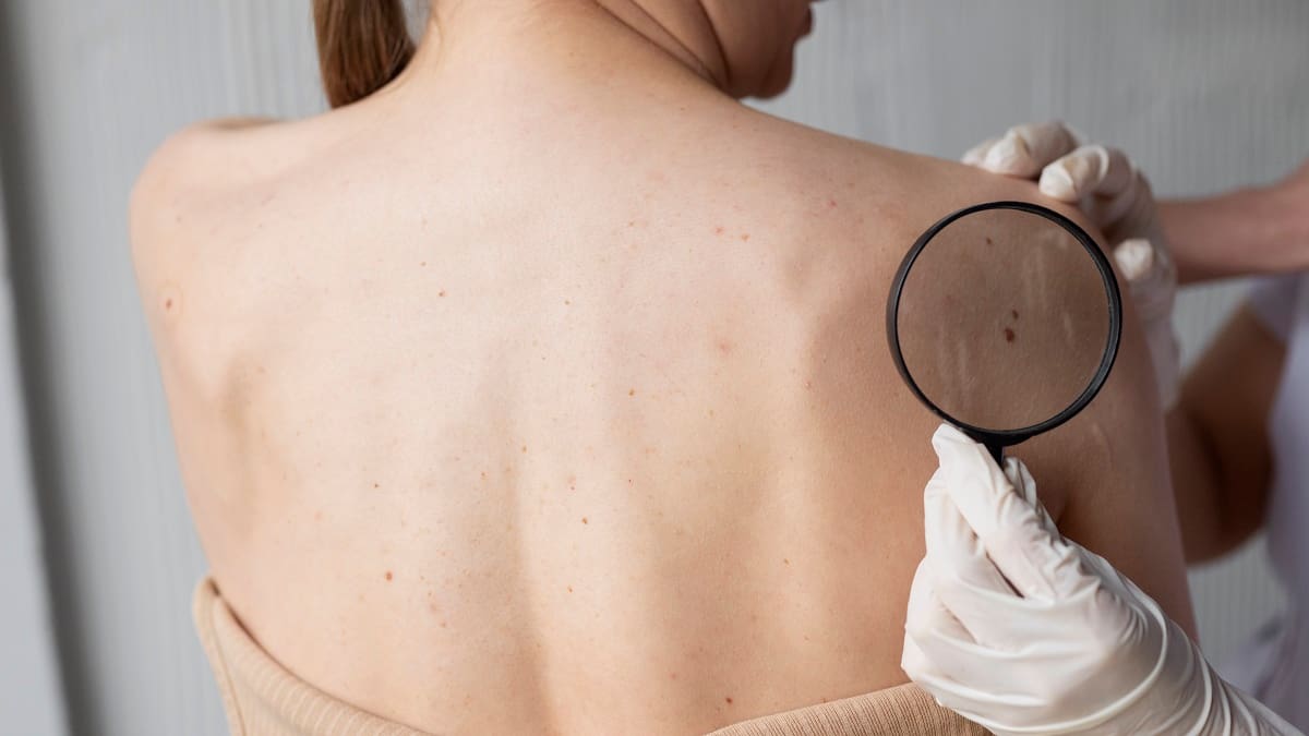 Cáncer de piel: la vacuna argentina para tratar el melanoma de alto riesgo ya está disponible