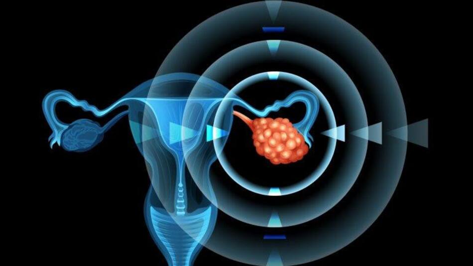 Cáncer de ovario
