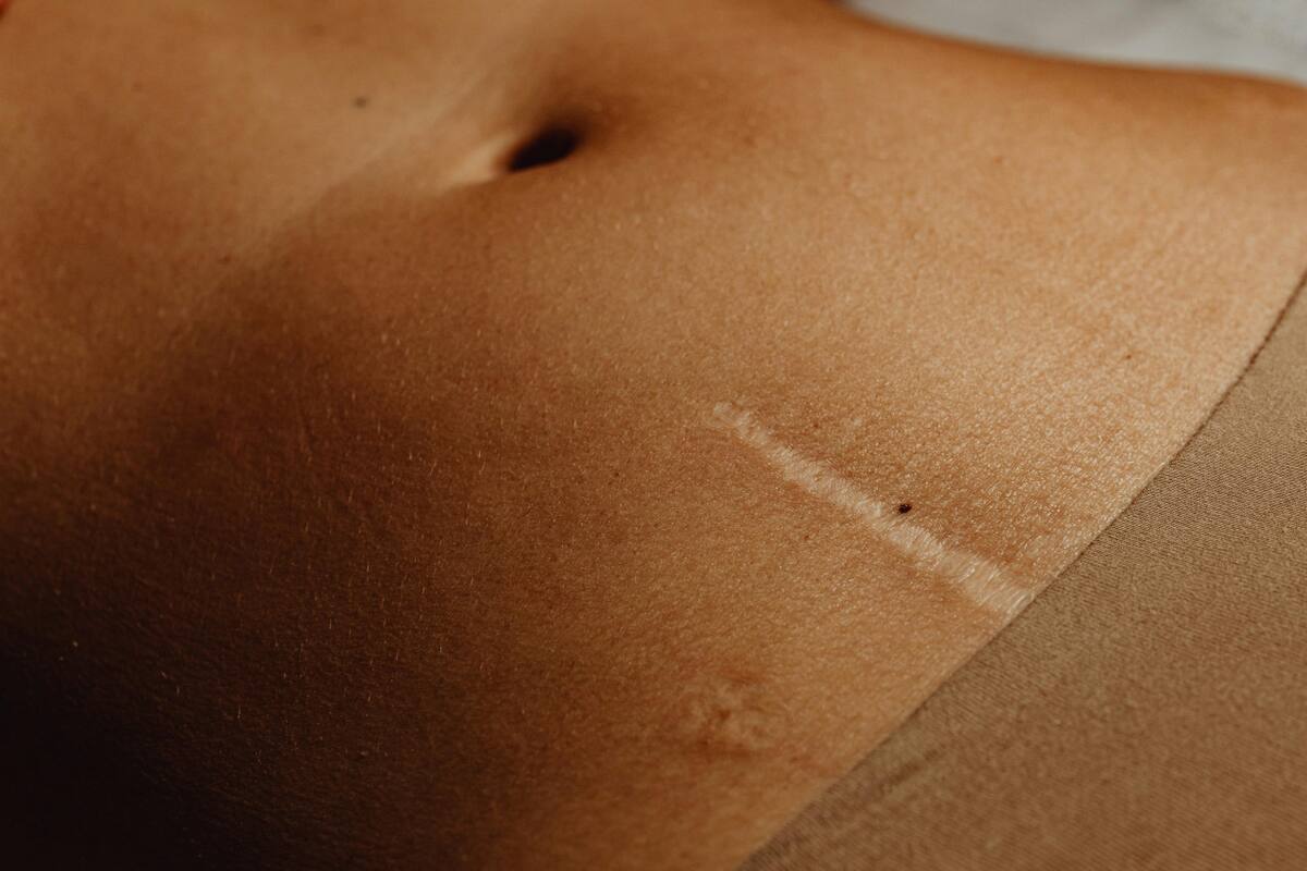 Cicatriz. Fuente: Pexels