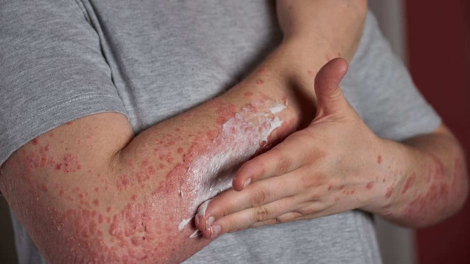 Urticaria por estrés. Foto: Freepik.