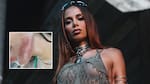 Anitta fue atacada por una medusa y sufrió quemaduras en su rostro: "El veneno salió de color marrón"