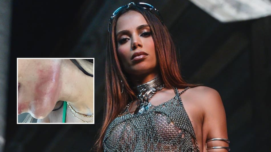 Anitta sufrió quemaduras en su cuerpo por una medusa.