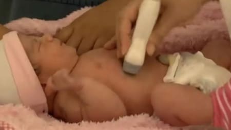 Itzamara, beba "embarazada" de su hermano gemelo