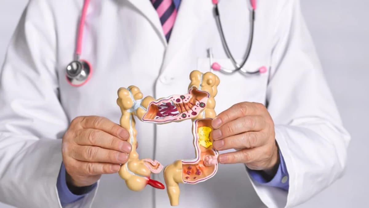 Cáncer de colon. Foto: NA.