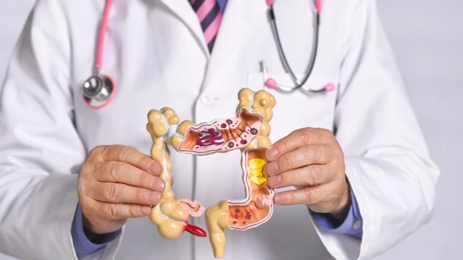 Cáncer de colon. Foto: NA.