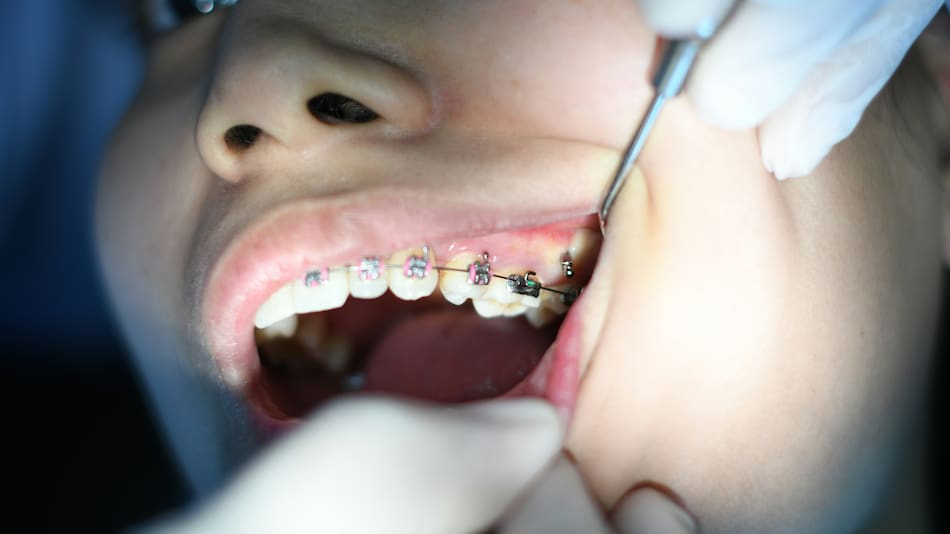Brackets odontológicos.