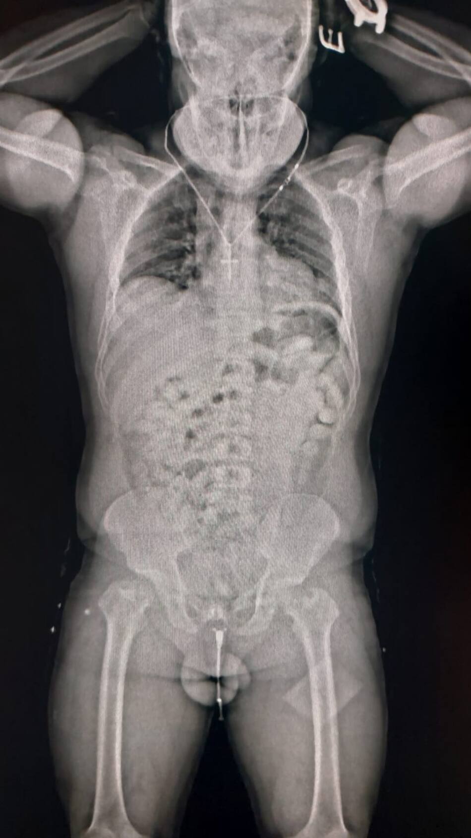 Aduana detuvo a un hombre que viaja a Europa con 84 cápsulas de cocaína en su organismo. Foto: Aduana.