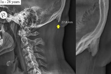 El uso del celular modificó el esqueleto humano