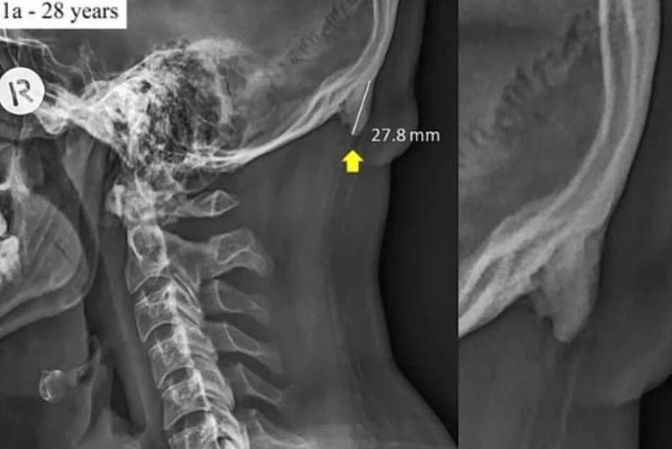 El uso del celular modificó el esqueleto humano