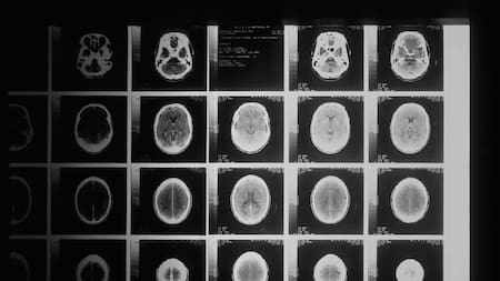 Tumores cerebrales. Foto: Unsplash.