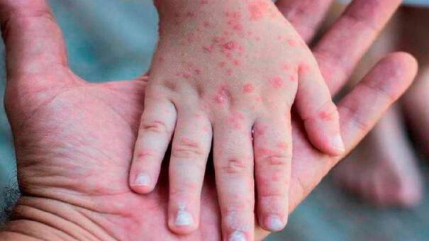 La OMS tomó una decisión clave respecto a la viruela del Mono: ¿puede causar otra pandemia?