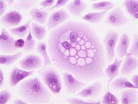 Cáncer de pulmón. Foto: Unsplash