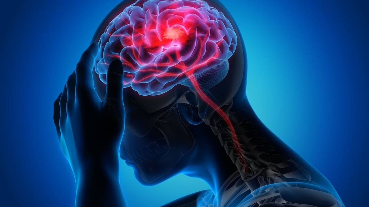 Migrañas. Foto: Pixabay