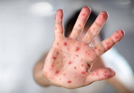 Viruela del mono. Foto: NA.