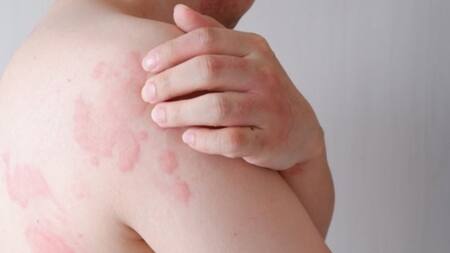 Los principales síntomas de la Urticaria crónica. Foto: X