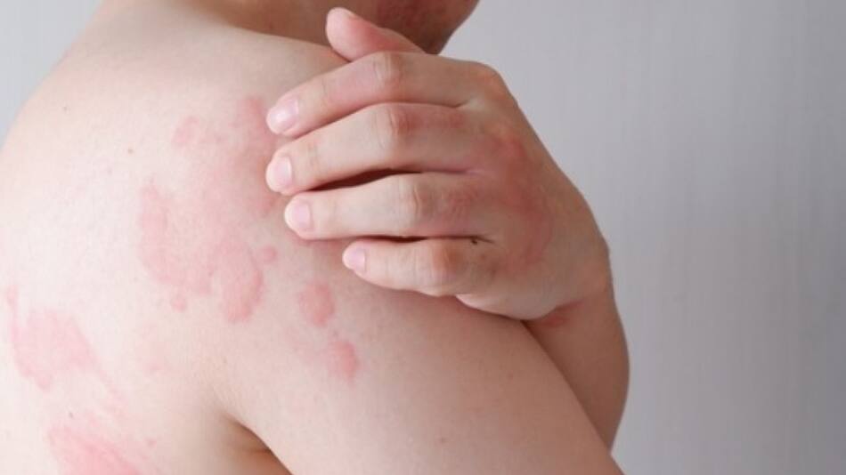 Los principales síntomas de la Urticaria crónica. Foto: X