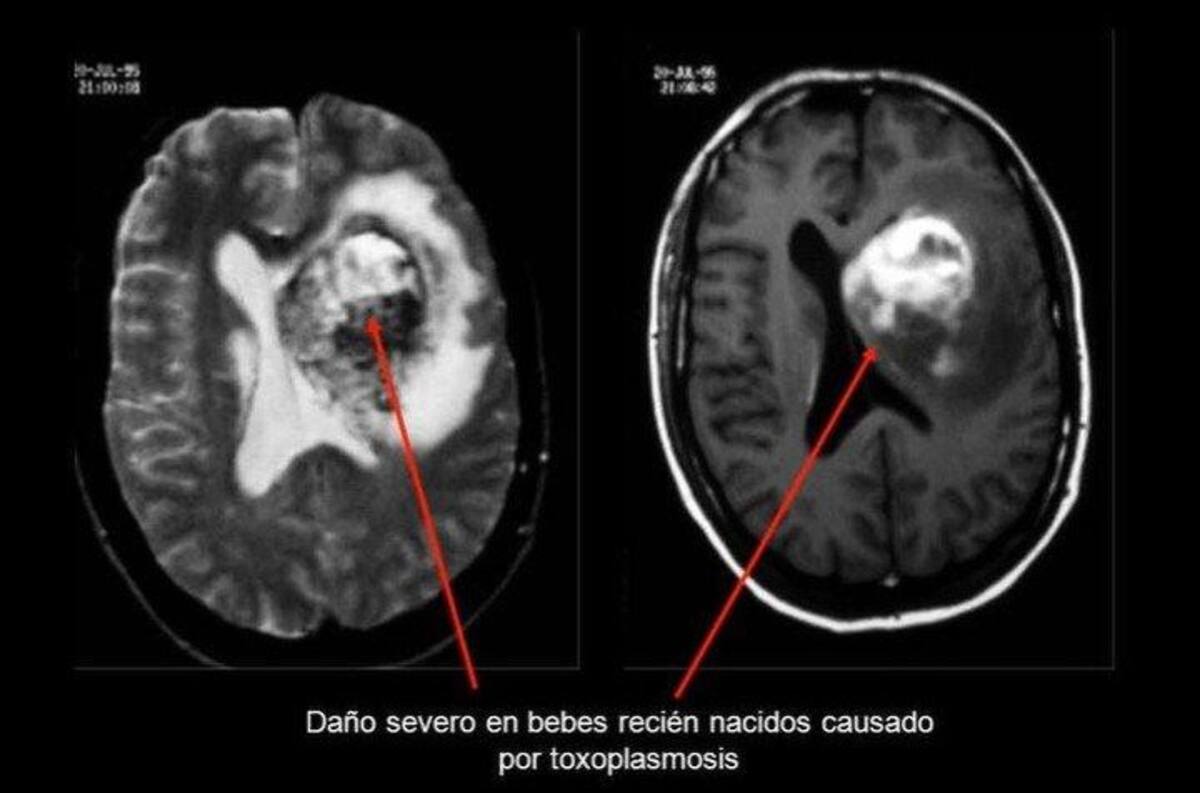 Parásito que ingresa al ser humano a través de gatos