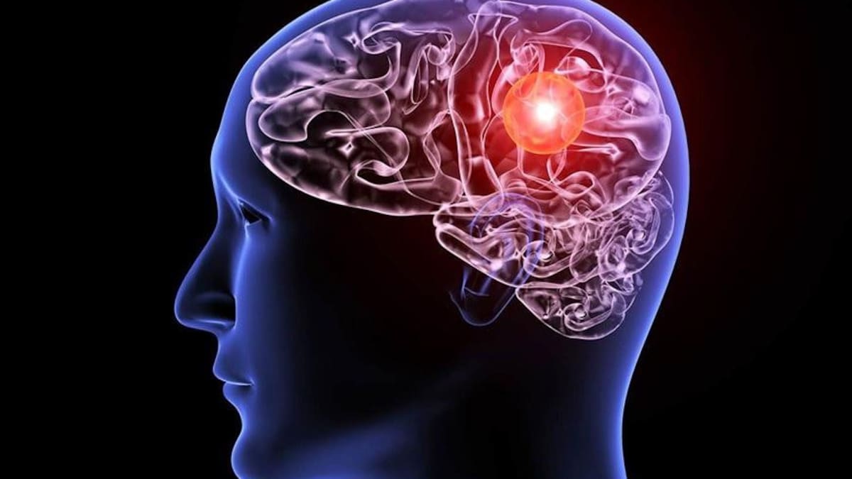 Aunerisma cerebral