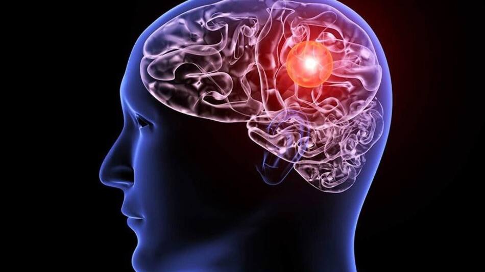 Aunerisma cerebral