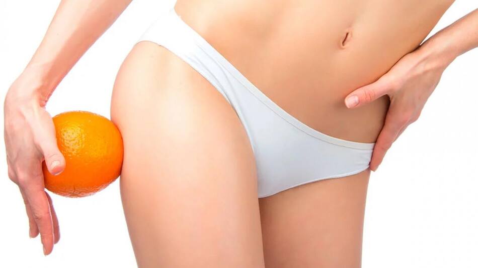 Celulitis - salud - tratamiento estético - piernas