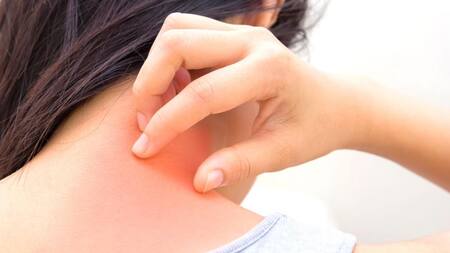 Psoriasis - tratamiento - Salud