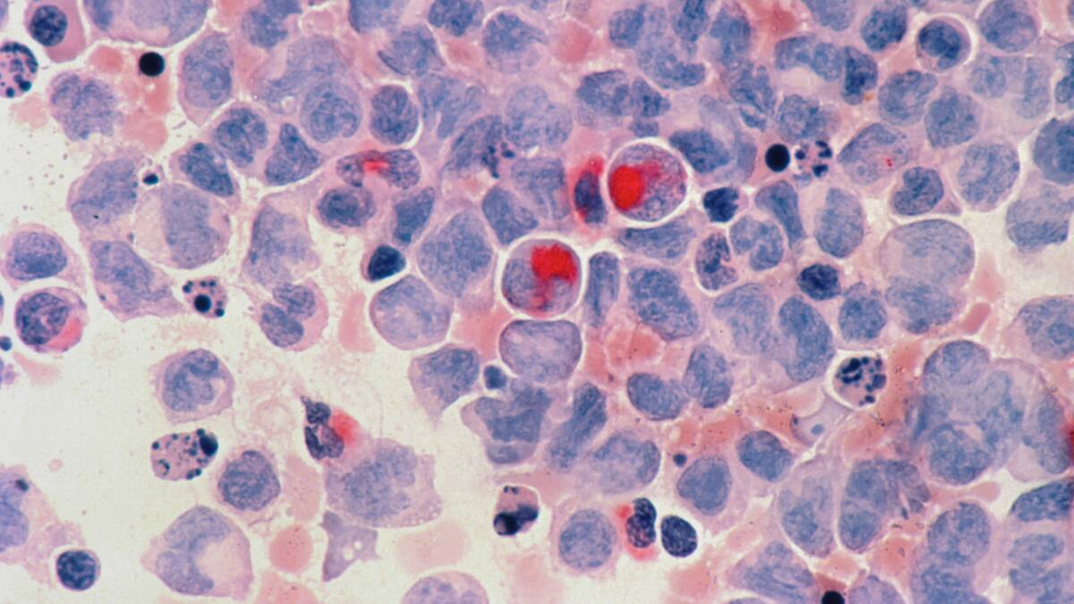 Cáncer. Foto: Unsplash